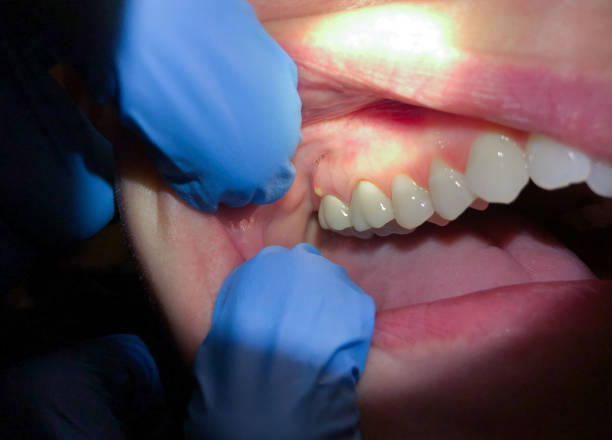 Best Emergency Wisdom Teeth Removal in Scotts Valley, CA