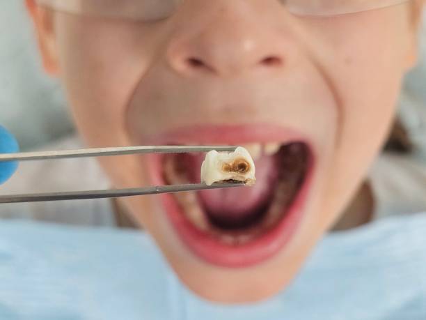 Best Emergency Treatment for Toothache in Scotts Valley, CA