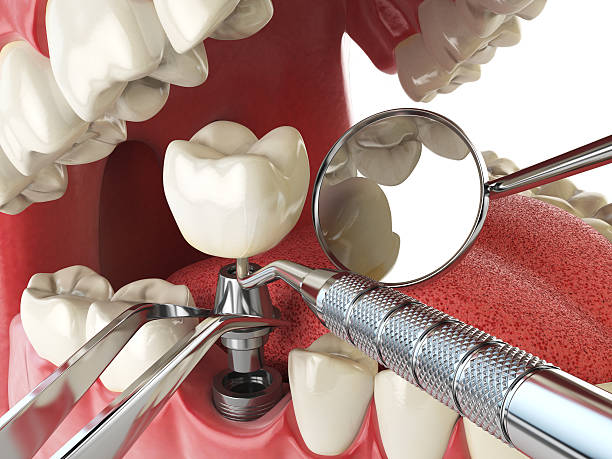 Best Emergency Broken Tooth Repair in Scotts Valley, CA